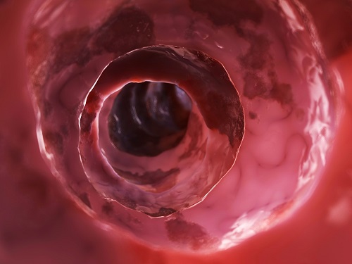 Colon irritado por bacterias 