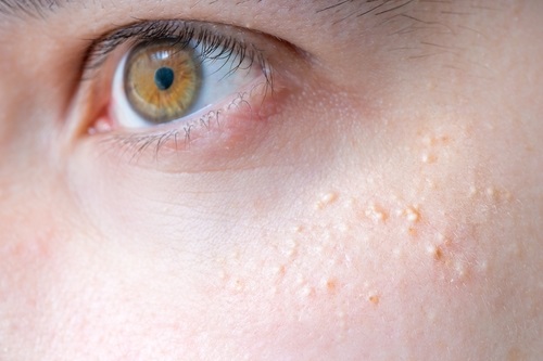 Consultar con el dermatólogo la aparición de sarpullido en el rostro