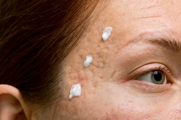 mascarilla con bicarbonato para el acné