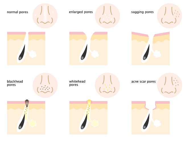 Gráfico que muestra las consecuencias de tener poros abiertos o dilatados