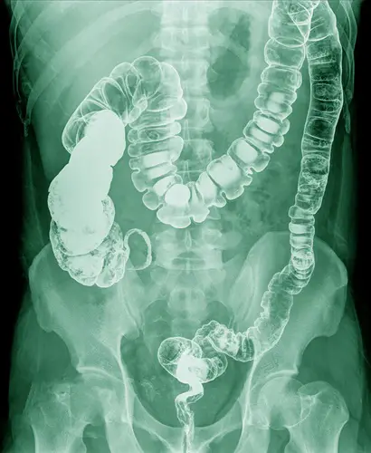 intestino-cargado-rayos-x-retener-las-heces