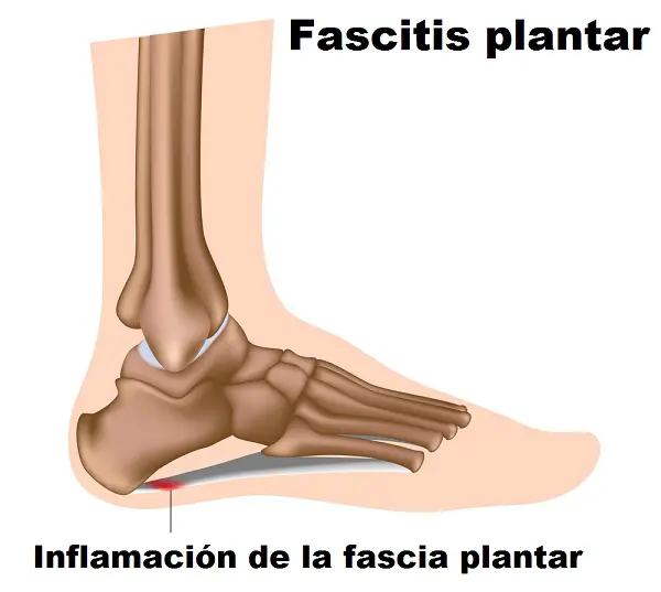 fascitis-plantar