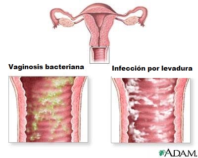 vaginosis bacterial 1