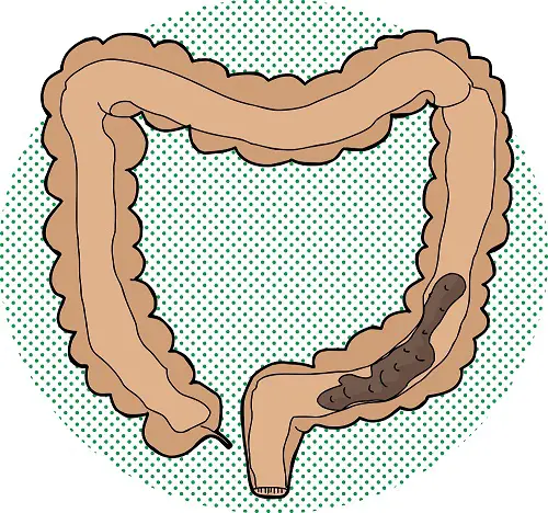 desalojar-el-intestino-colon-con-heces