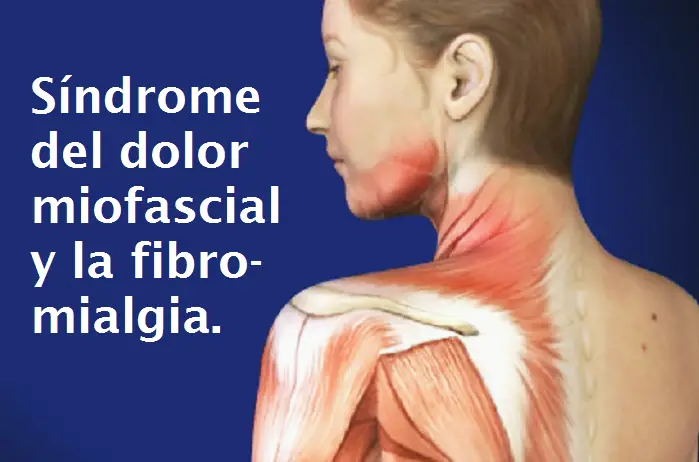 Síndrome del Dolor Miofascial y la Fibromialgia