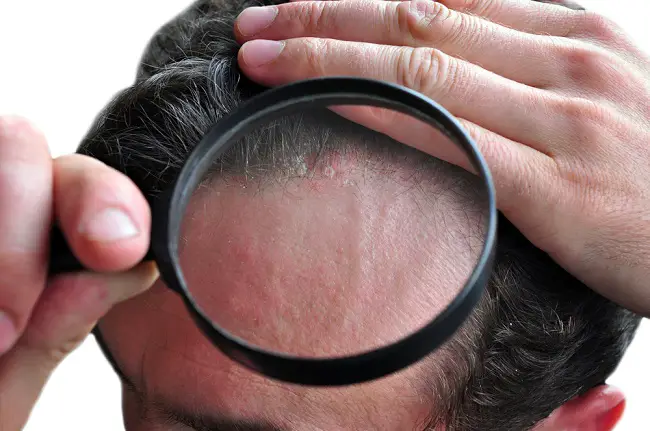 dermatitis-seborreica-2