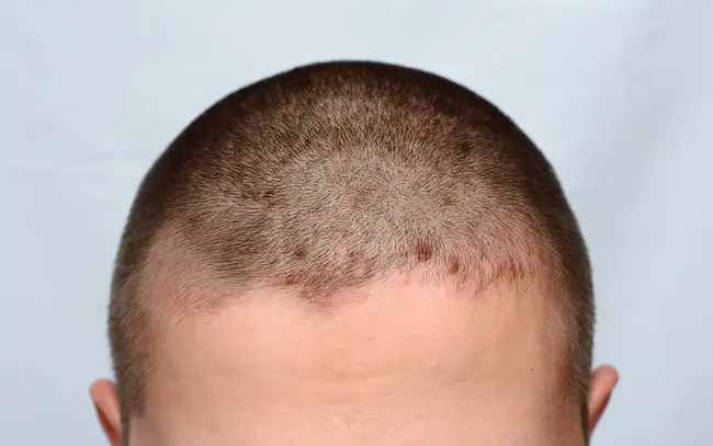 dermatitis-seborreica