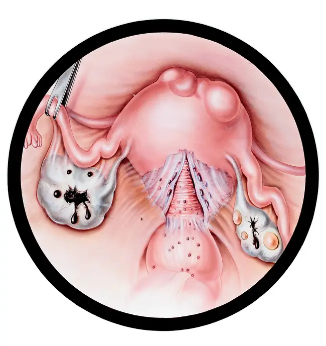 endometriosis-1