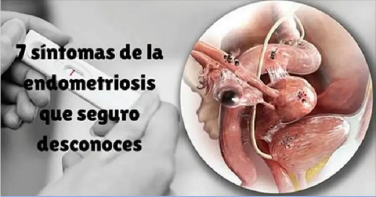Endometriosis intestinal sintomas