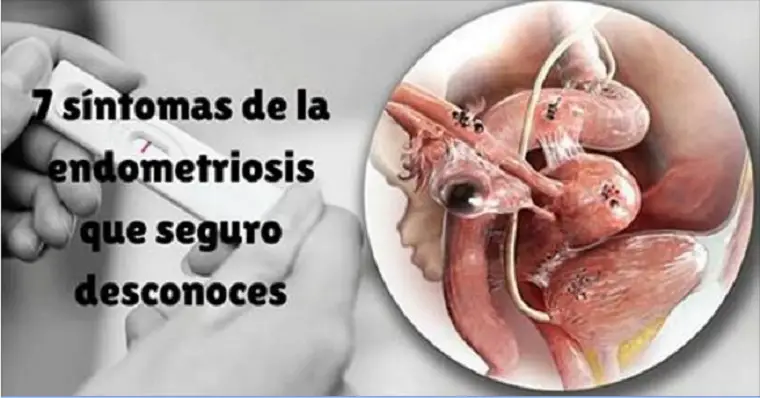 Alimentación endometriosis