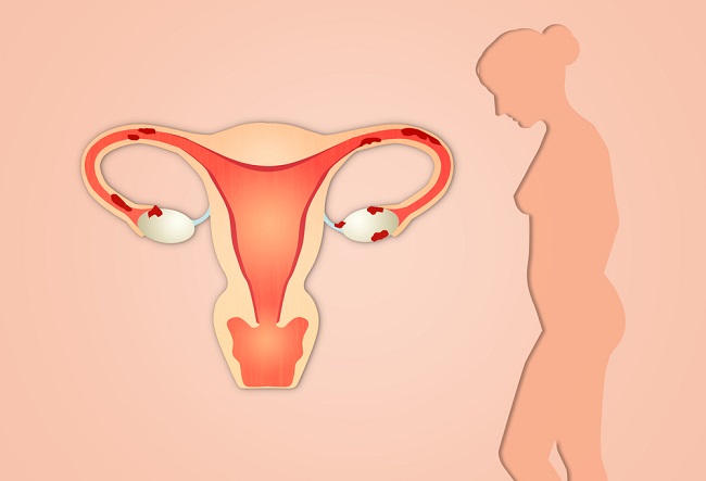 la-endometriosis