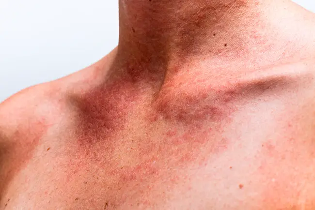 manchas en el cuello y pecho en una mujer joven