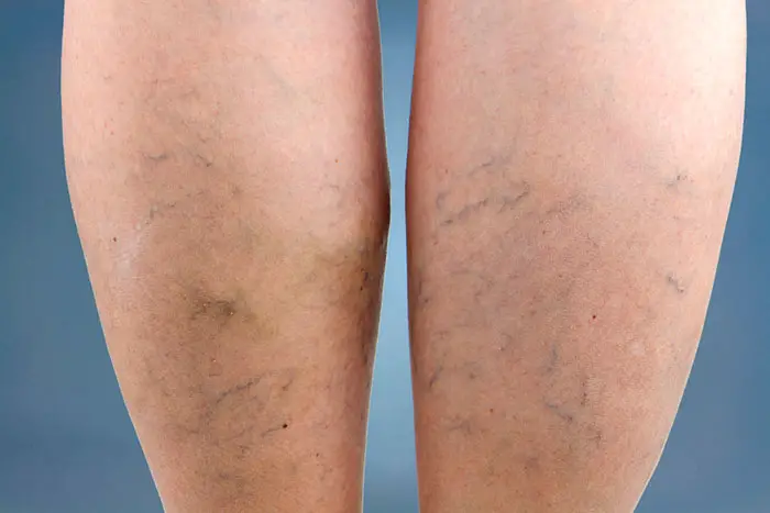 Piernas balncas de mujer con varices y arañas vasculares