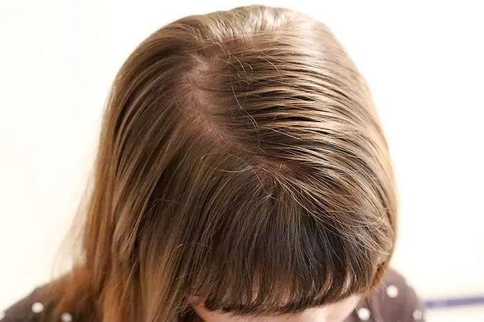 cheveux gras