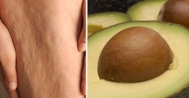 piel con celulitis y semillas de aguacate para tratarla