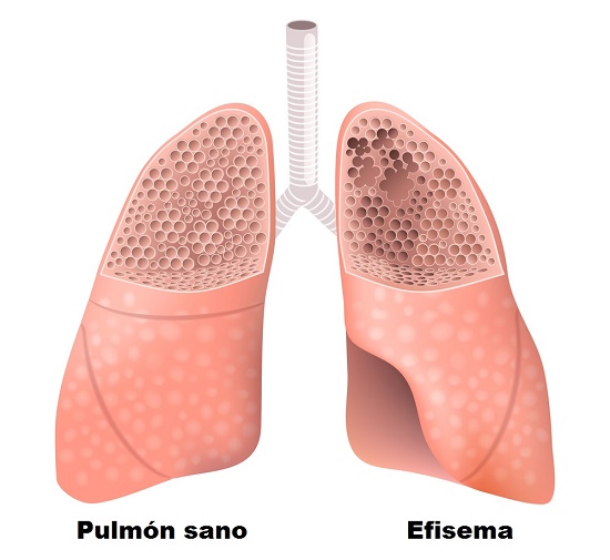 Enfermedad pulmonar obstructiva crónica