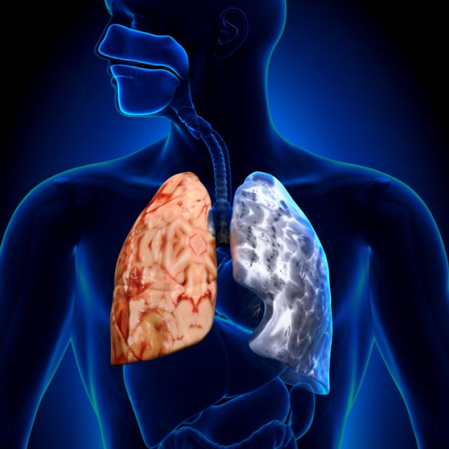 enfermedad pulmonar obstructiva