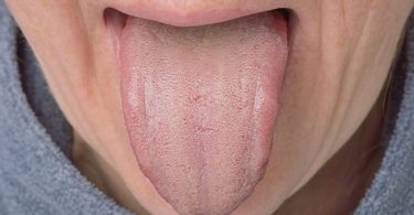 Hombre joven con lengua blanca y problemas estomacales