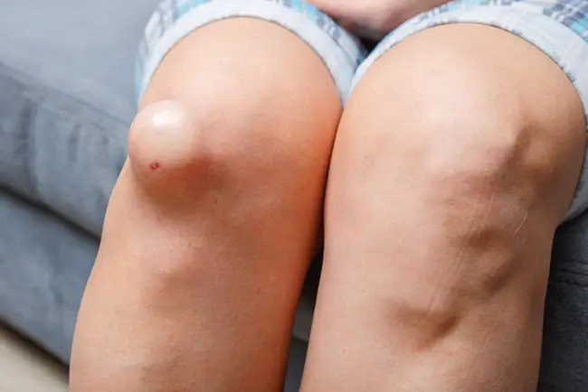 Mujer con líquido en las rodillas que necesita tratamiento