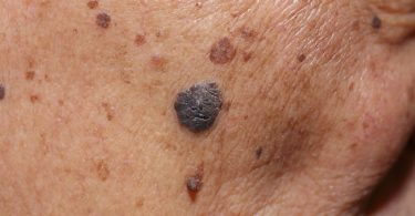 mujer con signos de cáncer en la piel