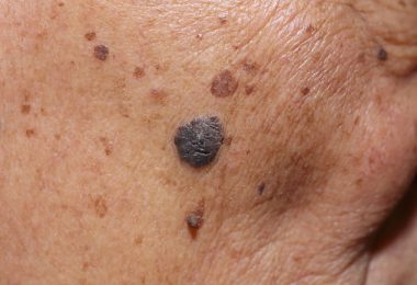 mujer con signos de cáncer en la piel