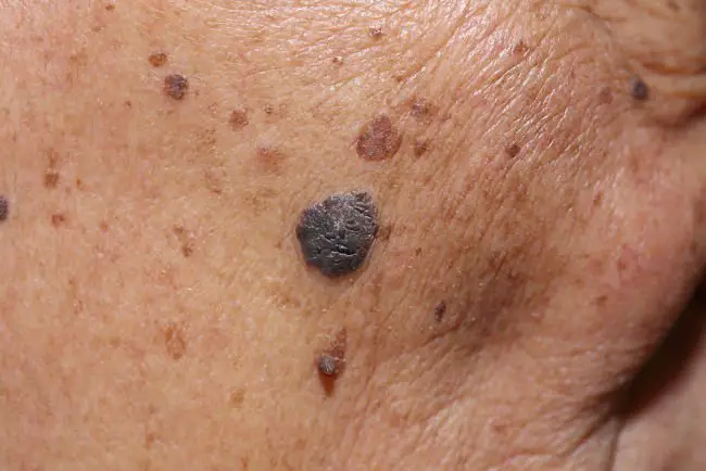 mujer con signos de cáncer en la piel