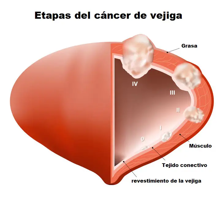 cáncer de vejiga etapas