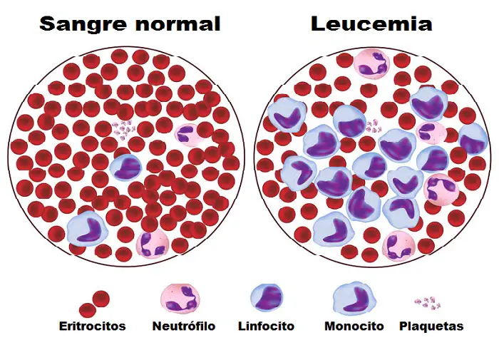 leucemia