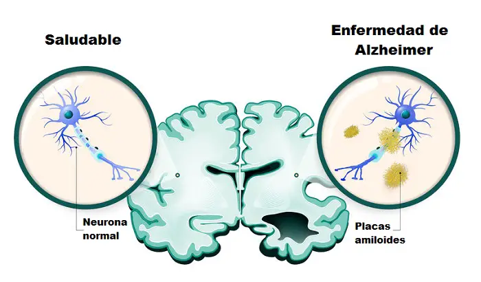 prevenir la enfermedad de alzheimer