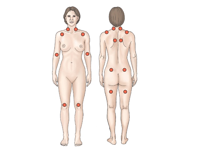 trigger points signs of fibromyalgia