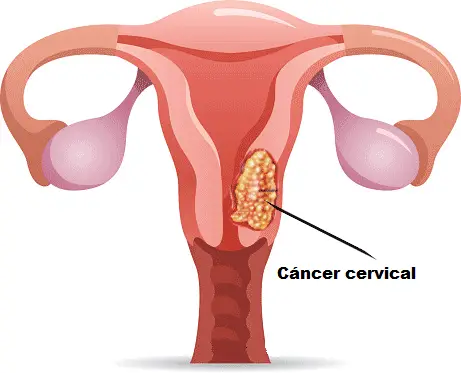 cáncer cervical ilustración