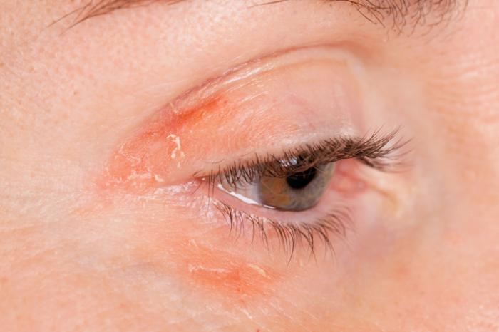 Irritación en los ojos por usar maquillaje vencido
