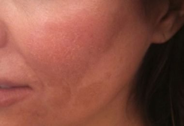 Mujer con manchas en su rostro