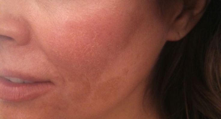 Mujer con manchas en su rostro