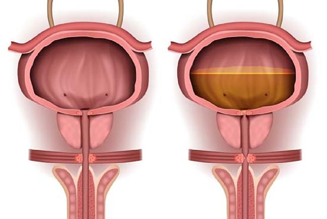 Retención urinaria y los problemas de salud que puede ocasionar