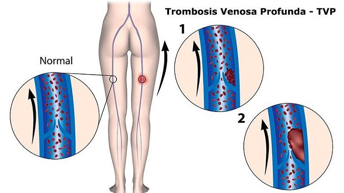 Coágulos de sangre por tombosis venosa profunda