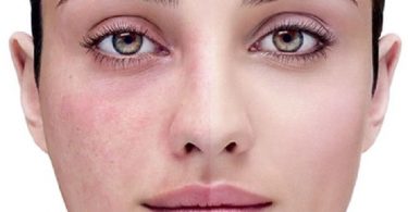 Mujer que muestra reacción alérgica en su rostro
