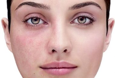Mujer que muestra reacción alérgica en su rostro