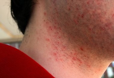 efectos de la irritación luego de rasurar la barba