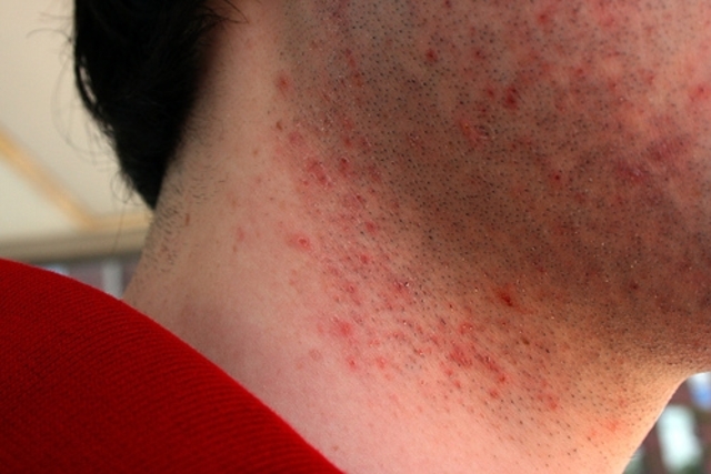 efectos de la irritación luego de rasurar la barba