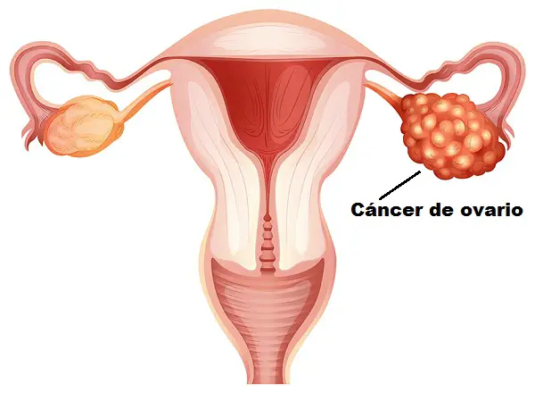 riesgo de cáncer de ovario
