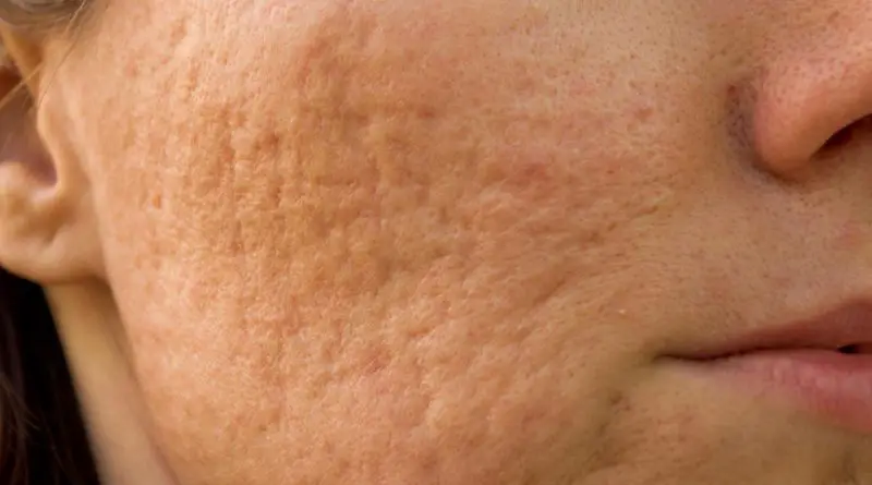 Los efectos del tabaquismo sobre el rostro del fumador