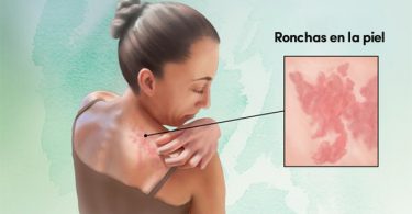 mujer con ronchas en la piel por la urticaria crónica