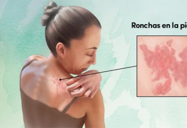 mujer con ronchas en la piel por la urticaria crónica