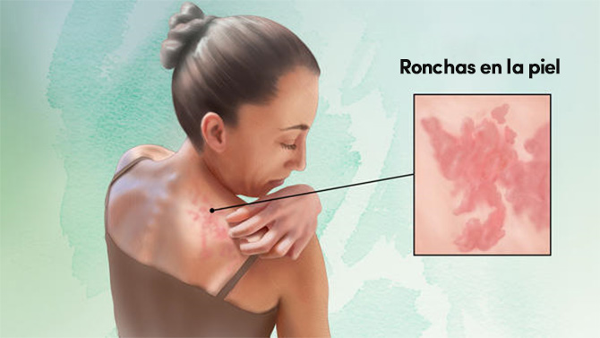 mujer con ronchas en la piel por la urticaria crónica