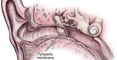 Timpano perforado cuales son sus causas y tratamientos