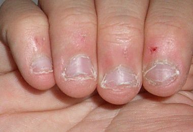 dedos con las uñas mordidas