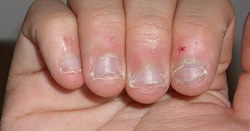dedos con las uñas mordidas