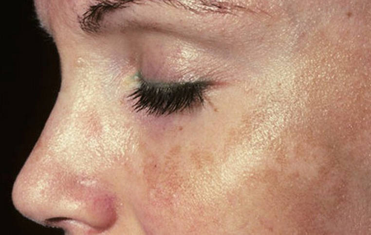 peau pigmentée sur le visage d’une femme