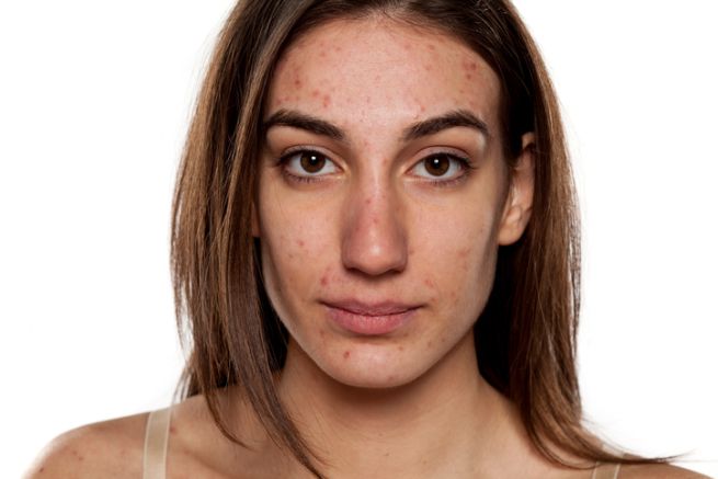 mujer con la piel de la cara con acné